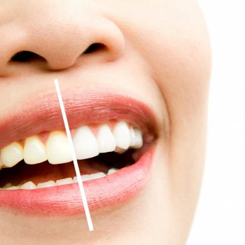 causas de los dientes amarillos